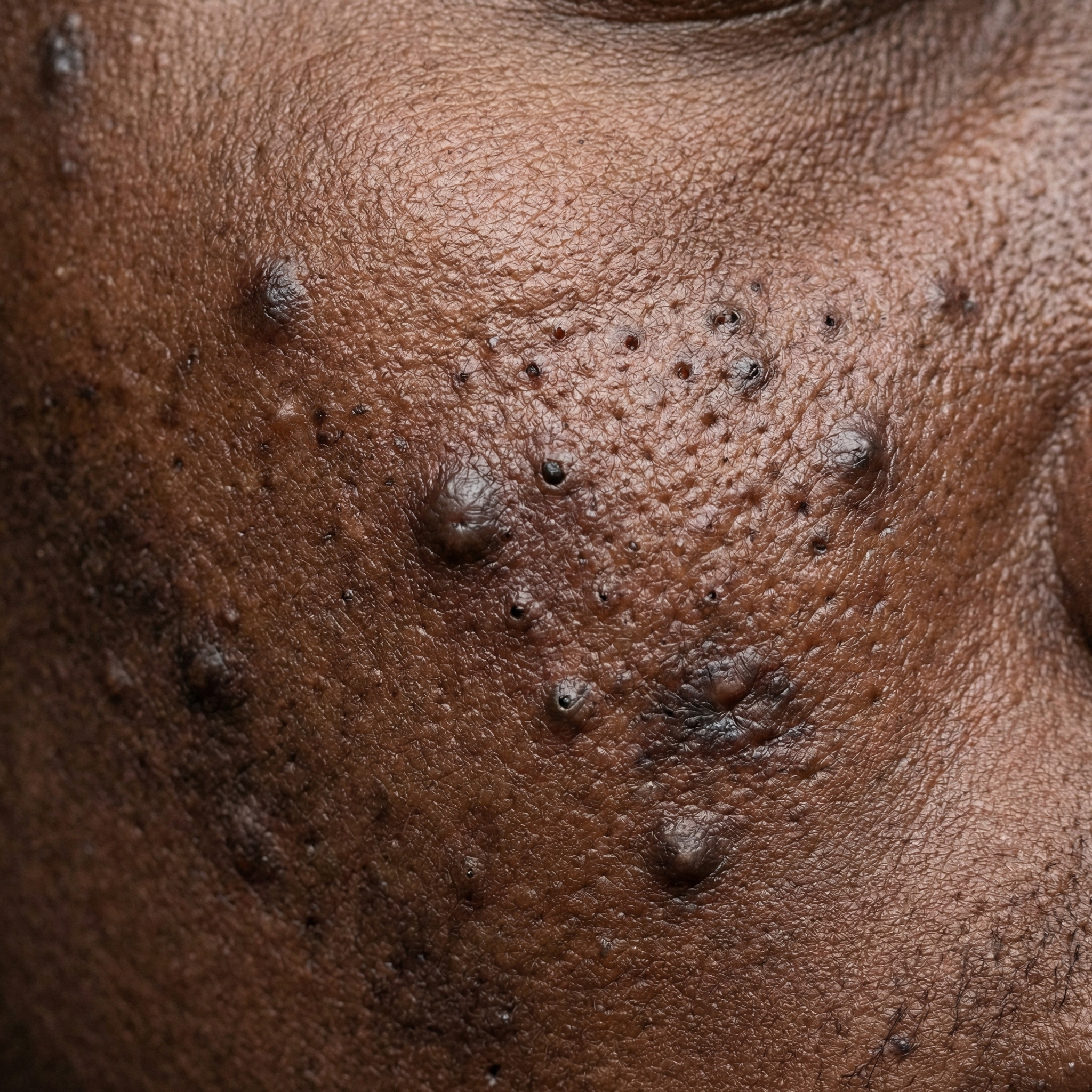 Pigmentflecken (Dunkel)