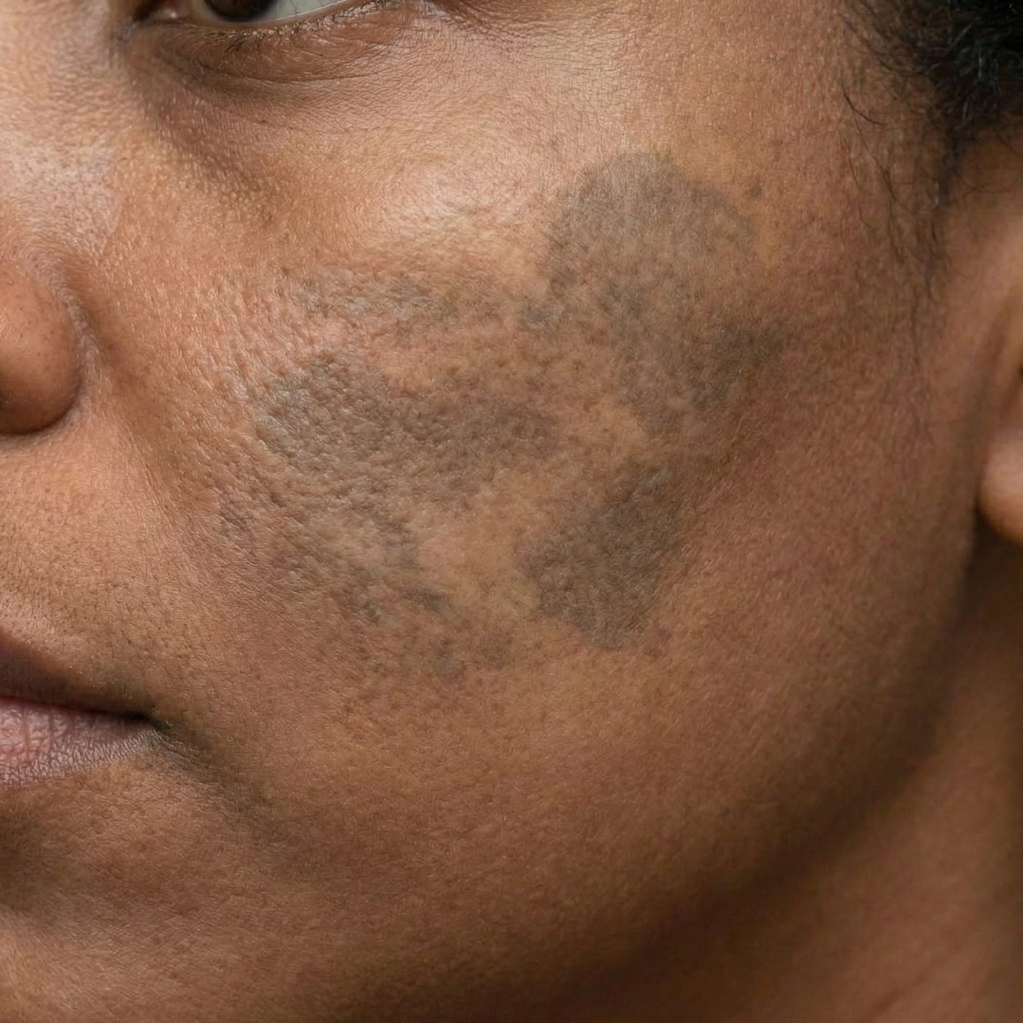 Melasma auf dunkler Haut